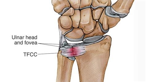 TFCC Tear – Julian Carlo, MD.