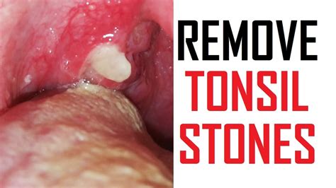 15 Ways To Remove Tonsil Stones At Home | Tonsil Stones Treatment - YouTube