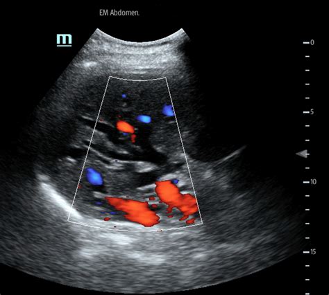 Cholangiocarcinoma Ultrasound