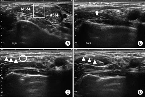 Ultrasound image of proximally approached suprascapular nerve block.... | Download Scientific ...