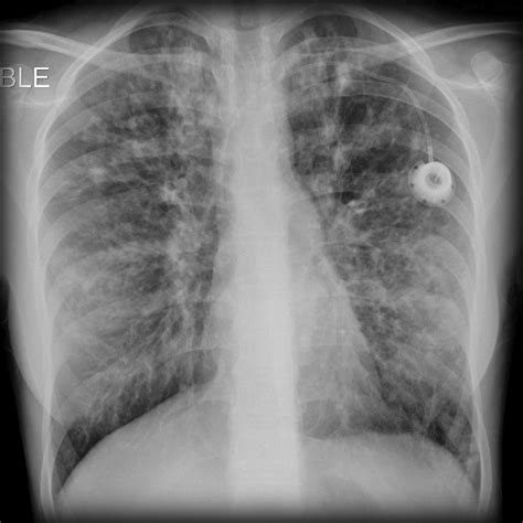 Cystic fibrosis chest x ray - wikidoc