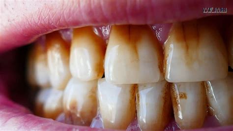 Why Are My Teeth Yellow When I Brush Them Everyday - GadgetsSai