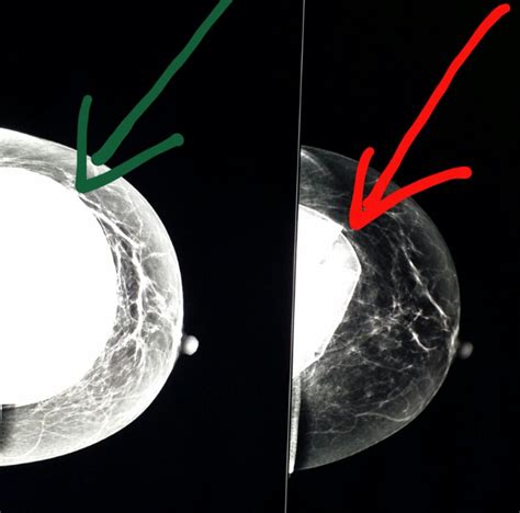 3d mammogram vs regular mammogram