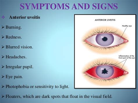 Uveitis ppt