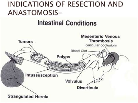 Resection & anastomosis of boweL its complications PRANAYA PPT