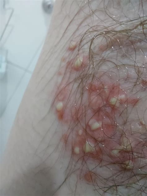 Pus filled bumps on armpits : r/DermatologyQuestions