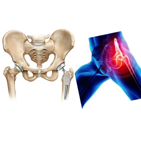 Hip Joint Replacement In Kharadi | Dr Abhishek Patil | Joints For Life