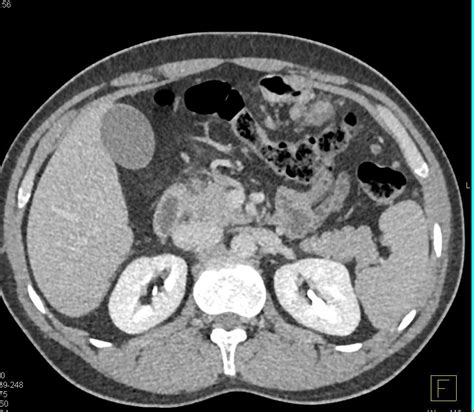 Omental Carcinomatosis - Gastrointestinal Case Studies - CTisus CT Scanning