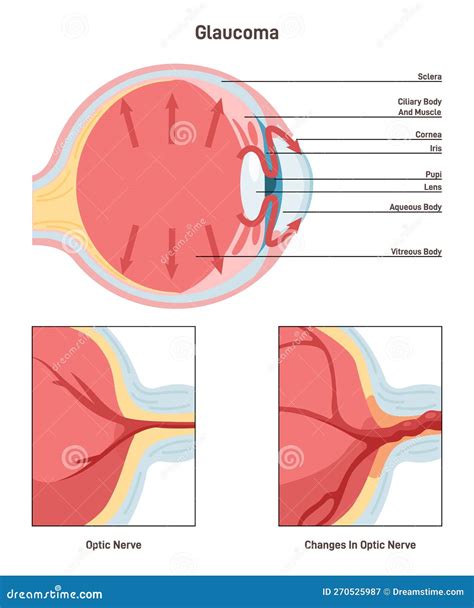 Glaucoma. Damage To the Optic Nerve and Can Lead To Vision Loss Stock ...