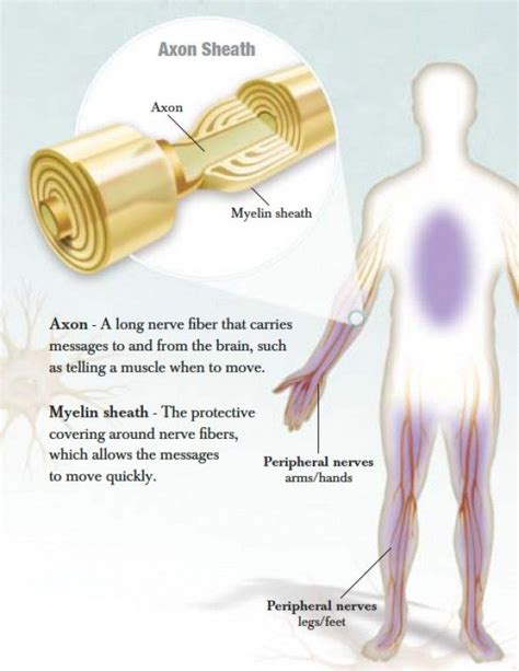 Chronic inflammatory demyelinating polyneuropathy (CIDP) « | Cidp ...