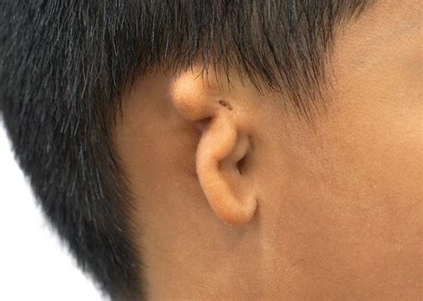 Otoplasty | Best Surgeon | Ear Surgery NYC - Understanding Anotia and How Reconstructive ...