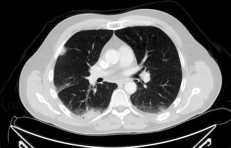 Bronchiolitis Obliterans Organizing Pneumonia/Cryptogenic Organizing ...