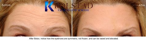 Remove Forehead Wrinkles with Botox Before & After Gallery 16 | Dr ...