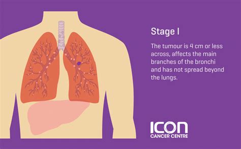 Stage 1 Of Lung Cancer