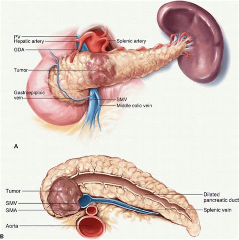 Pancreatoduodenectomy | Oncohema Key