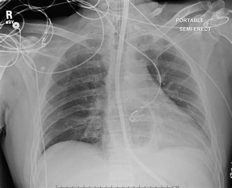 Esophageal Perforation after Segstaken-Blakemore Tube Placement Treated with Esophageal Stenting ...