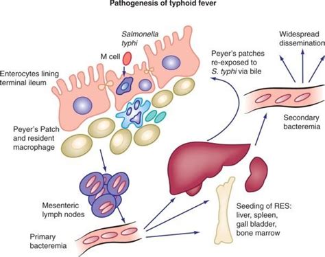 Diagnosis And Complications Of Typhoid - Fastalobos