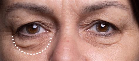 Are You Considering Eye Bag Removal Surgery? First, find out about opt