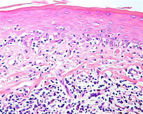 Mycosis Fungoides Histopathology