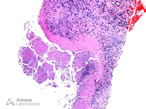 Caseating Granuloma Histology