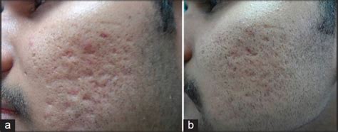 (a) Grade 4 acne scars; (b): Improvement in acne scars from Grade 4 to... | Download Scientific ...