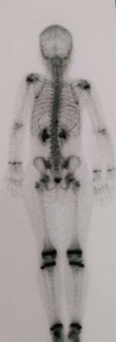 Bone scintigraphy. The image shows a slight increase in osteoblastic ...