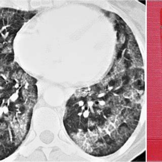 Left panel: CT-scan showing bilateral diffuse crazy paving patterns;... | Download Scientific ...