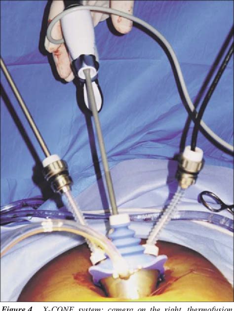 Subtotal Hysterectomy with Single Port Access Laparoscopy: Gadget or ...