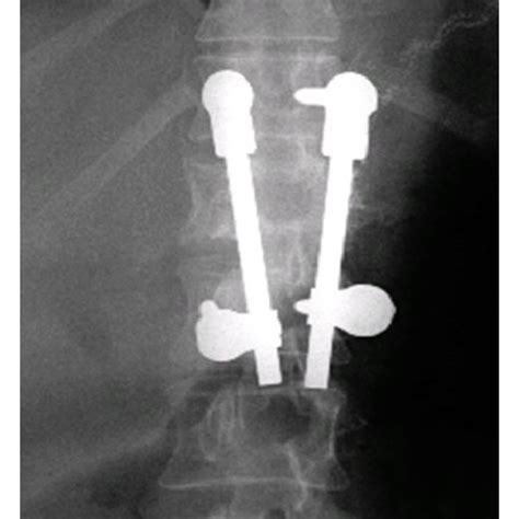 X-ray showing a burst fracture of T12. | Download Scientific Diagram