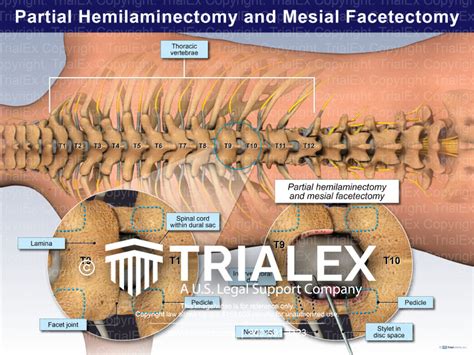 Partial Hemilaminectomy and Mesial Facetectomy - TrialExhibits Inc.