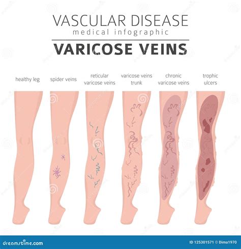 Vascular Diseases. Varicose Veins Symptoms, Treatment Icon Set Stock Vector - Illustration of ...