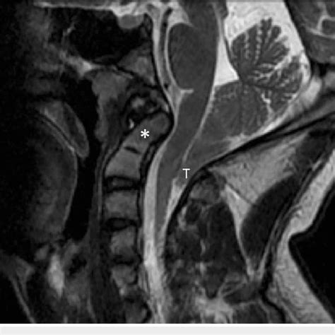 T2-weighted, sagittal MRI Note the herniated cerebellar tonsils (T)... | Download Scientific Diagram