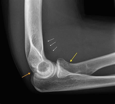 Radial neck fracture - Radiology at St. Vincent's University Hospital