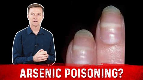 Identify Arsenic Poisoning Through Your Nails - YouTube