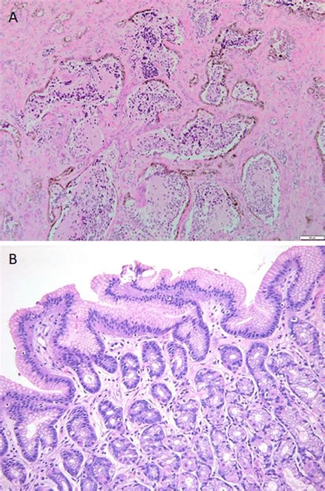 (a) Histologic appearance of a melanotic neuroectodermal tumor of ...