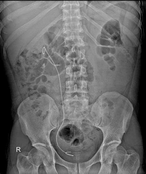 KUB X-Ray Showing DJ Stent Right Kidney To Bladder Stock Photo - Image of radiological, stent ...