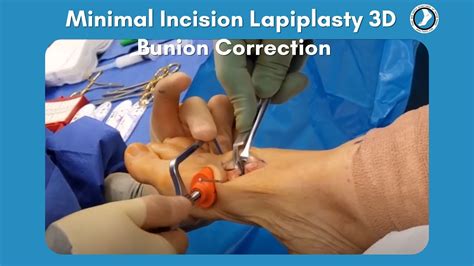 Minimal Incision Lapiplasty 3D Bunion Correction - YouTube