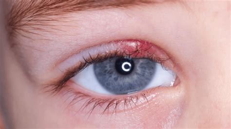 What Is An Eye Stye? Causes, symptoms, and Treatment