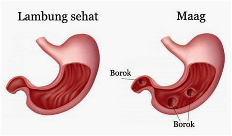 Gejala, Penyebab dan Pengobatan Maag (Gastritis) | Medkes