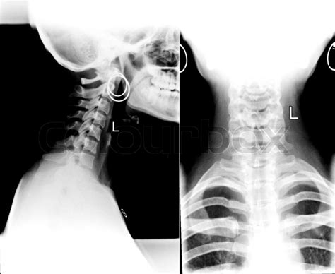 Detail of neck x-ray image | Stock image | Colourbox