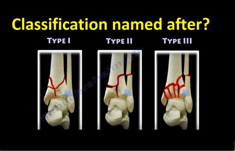 Tibial Pilon Fracture Classification — OrthopaedicPrinciples.com