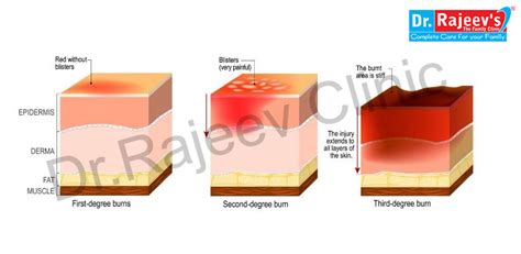 Homoeopathic treatment for Burn