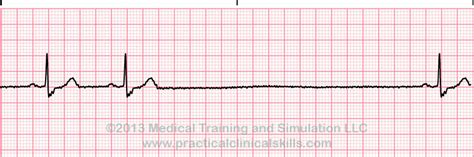 EKG | Electrocardiogram