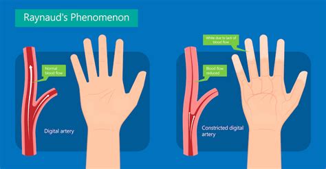 Raynaud's Syndrome: Symptoms, Causes Treatment, 43% OFF