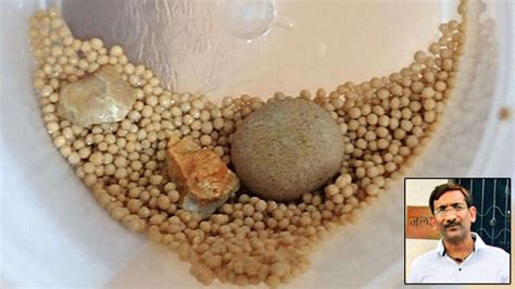 Delhi: 45-year-old gets 856 kidney stones removed from body