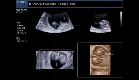 Ultrasound imaging: Fetal 3D-ultrasound images at 10 weeks