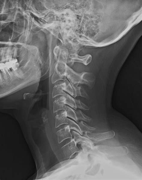 Normal Radiographic Anatomy of the Cervical Spine | Raio x, Radiologia, Coluna cervical