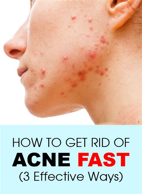 How To Get Rid of Acne Fast (3 Effective Ways) | Natural acne treatment, How to get rid of acne ...