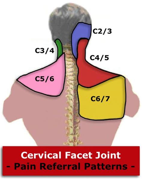 Cervical Facet Pain Referral Pattern | Cervical Facet Syndrome | Nursing Stuff | Pinterest ...