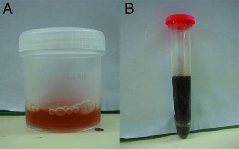 A, Gross hematuria in the drainage bag. B, Red-colored fluid taken from... | Download Scientific ...